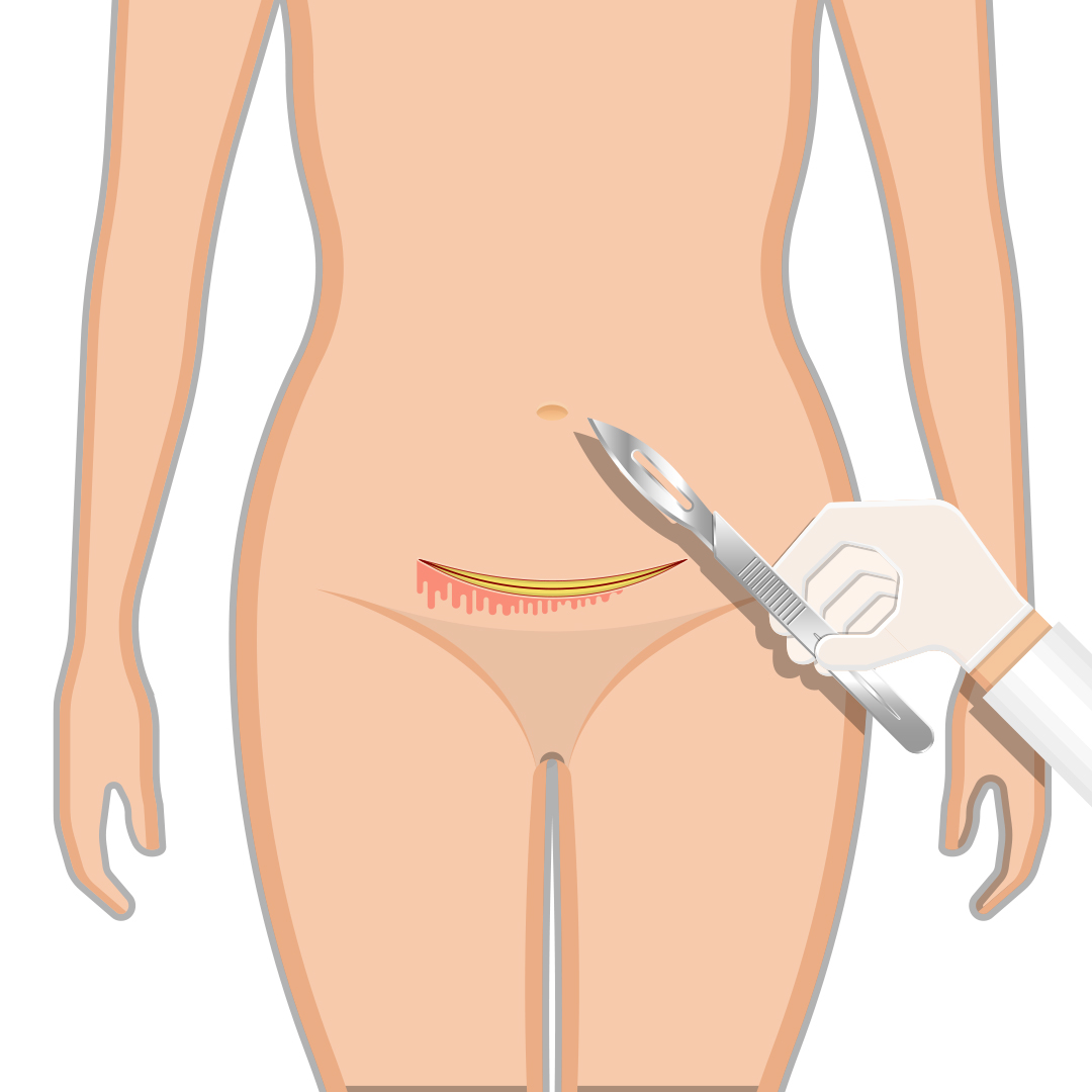 Abdominal hysterectomy treatment