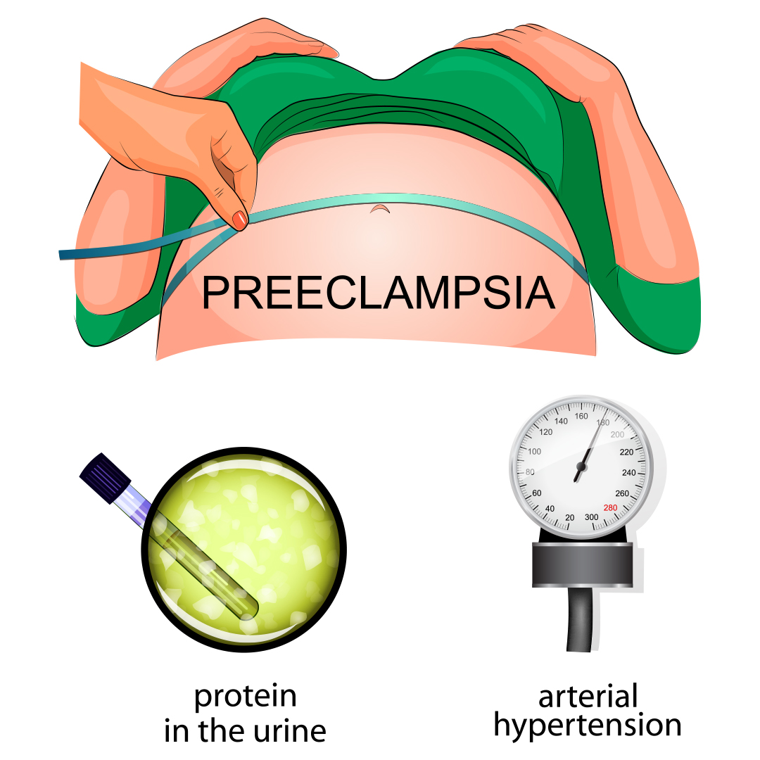 pregnant women with preeclampsia